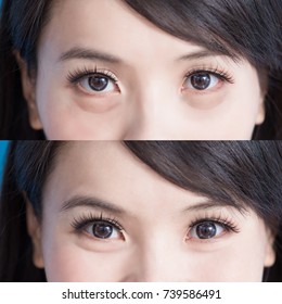 Woman Eye Bags Vefore And After On The Blue Background