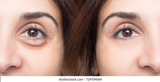 Woman eye before and after cosmetic treatment with and without e