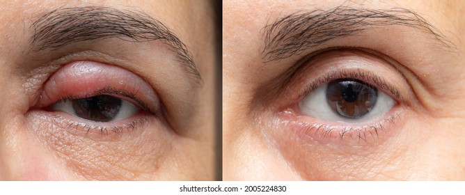Woman Eye Before And After Stye Treatment. Swollen Eye On The Eyelid Which Then Appears Deflated And Healthy