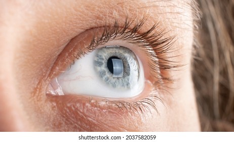 woman eye with corneal dystrophy, keratoconus, thinning of the cornea.