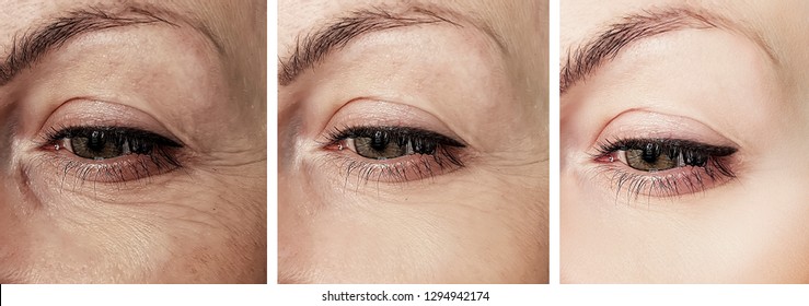 Woman Eye Wrinkles Before And After Procedures