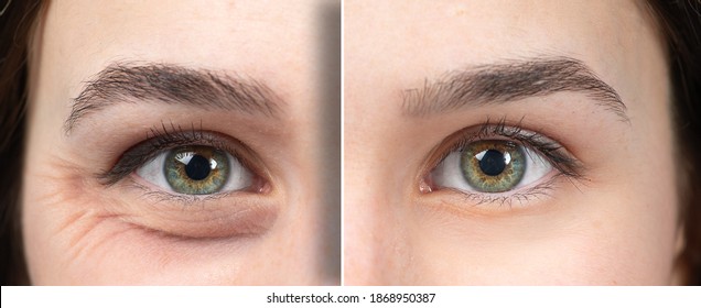 Woman eyes before and after an anti age treatment for wrinkles and crow's feet