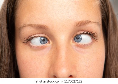 Woman Eyes Suffering From Strabismus