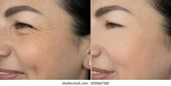 Woman Eyes Wrinkles Before And After Treatment