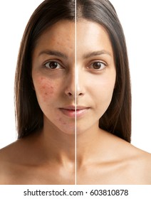 Woman Face Before And After Acne Treatment Procedure. Skin Care Concept.