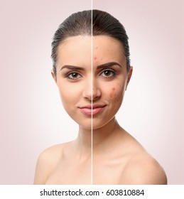 Woman face before and after acne treatment procedure. Skin care concept.