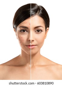Woman Face Before And After Acne Treatment Procedure. Skin Care Concept.