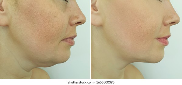 woman face double chin   after treatment