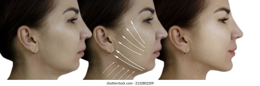 Woman Face Double Chin Before And After