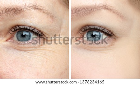 Woman face, eye wrinkles before and after treatment - the result of rejuvenating cosmetological procedures of biorevitalization, face lifting and pigment spots removal.