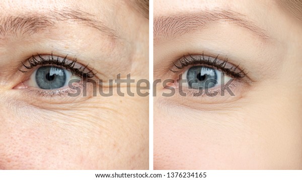 Woman face, eye\
wrinkles before and after treatment - the result of rejuvenating\
cosmetological procedures of biorevitalization, face lifting and\
pigment spots removal.