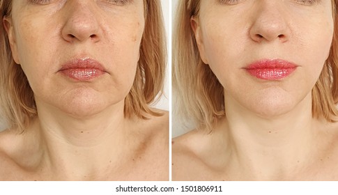 Woman Face Lift   After Treatment