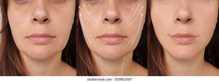 woman face lift before and after treatment