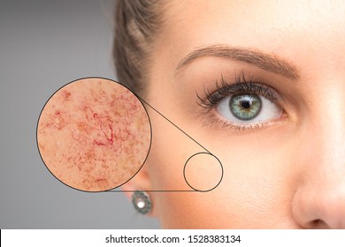 Woman Face Skin Imperfection, Capillaries In Zoom Circle 