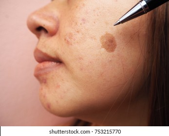 Woman Face With Skin Problems, Melasma, Acne Scar, Skin Problems Concept   