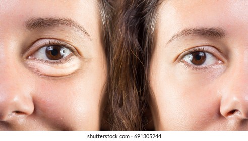 Woman Face With And Without Eye Bags Before And After Cosmetic Treatment