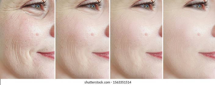 Woman Face Wrinkles   After Treatment Collage