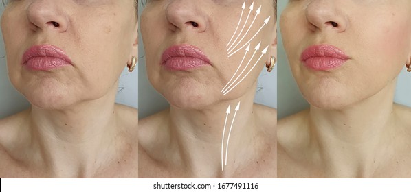 Woman Face Wrinkles   After Treatment, Thread Lifting