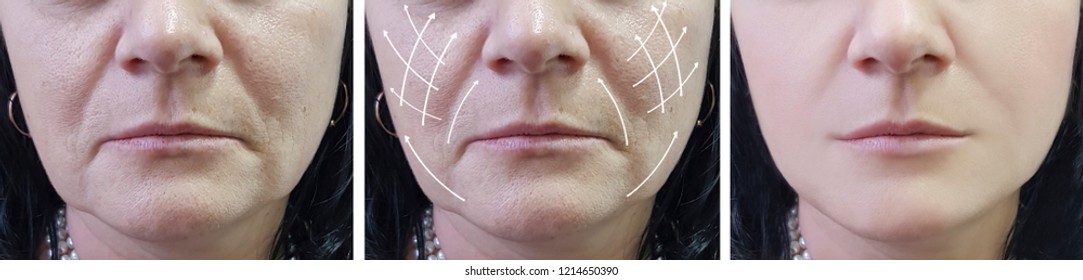 Woman Face Wrinkles Before After Procedures Foto Stok 1214650387 Shutterstock 2251