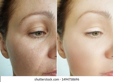 Woman Face Wrinkles Before And After Treatment