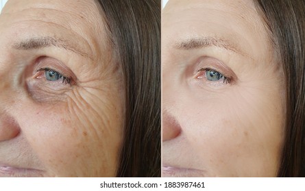 Woman Face Wrinkles Before After Treatment Stock Photo (Edit Now ...