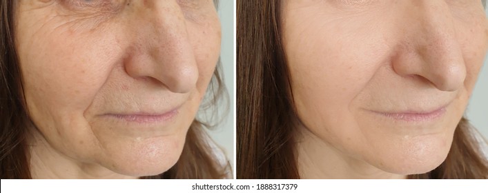 Woman Face Wrinkles Before And After Treatment