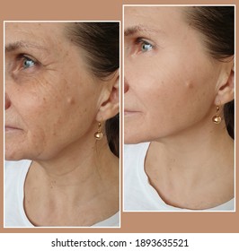 Woman Face Wrinkles Before And After Treatment