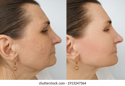 Woman Face Wrinkles Before And After Treatment