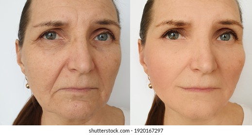 Woman Face Wrinkles Before And After Treatment