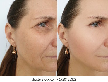 Woman Face Wrinkles Before And After Treatment