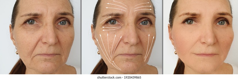 Woman Face Wrinkles Before And After Treatment