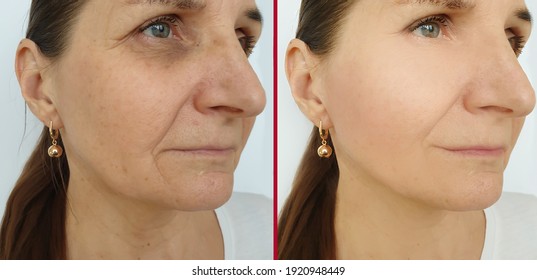 Woman Face Wrinkles Before And After Treatment