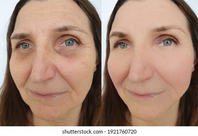 Woman Face Wrinkles Before And After Treatment
