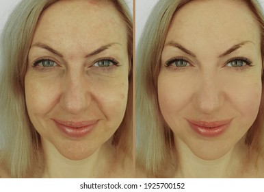 Woman Face Wrinkles Before And After Treatment