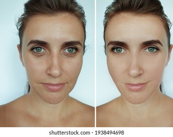 Woman Face Wrinkles Before And After Treatment
