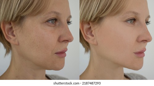 Woman Face Wrinkles Before And After Treatment