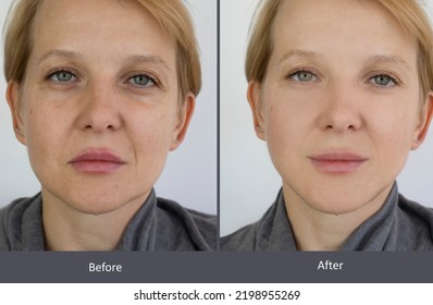 Woman Face Wrinkles Before And After Treatment