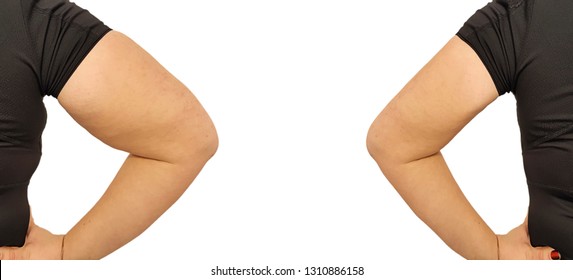 woman fat hand before and after procedures