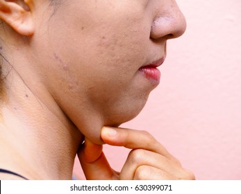 Woman With Fat Neck(side View), Chin Fat, Fat Woman, Beauty Concept