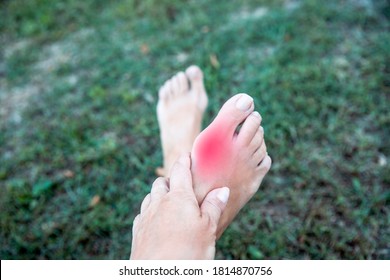 Woman Feeling Discomfort Outdoor Taking Off Shoes Cause Bone Arthritis Pain. Massage Bare Foot  Painful Bunion.
Red Spot On Feet 
Bunion Pain. 