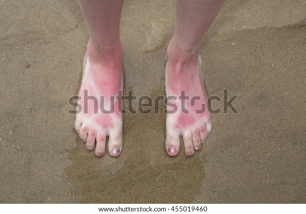 日焼けの跡を持つ女性の足 やけどした肌 の写真素材 今すぐ編集