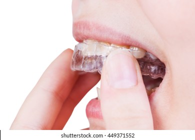 Woman Fixes Clear Aligner On Teeth For Orthodontic Correction Of Bite Isolated On White Background