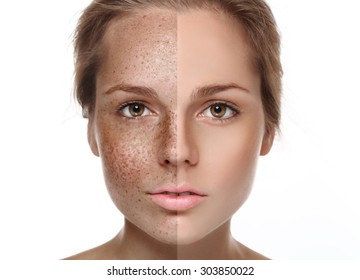 Woman Freckle Half-face Happy Young Beautiful Studio Portrait  Healthy Skin Half