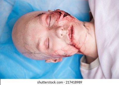 Woman Getting Into The Accident Having A Big Terrible Gash On Her Face Lying On The Operating Table. Top View