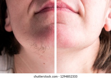 Woman with hairs on chin. Hair removal on face.