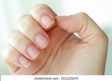 Woman Hand With Brittle Weak Nails And White Spots