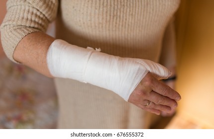 Woman With Hand In Gypsum. Selective Focus.