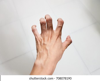 Woman Hand Spasticity And Hypermobile Fingers