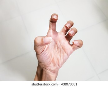 Woman Hand Spasticity And Hypermobile Fingers