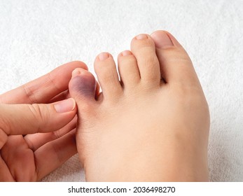 Woman hand touching little toe with purple bruise after home accident. Looking at bruised pinky toe of female person foot. Injury of foot little finger. Broken toe or phalange fracture. Top view.